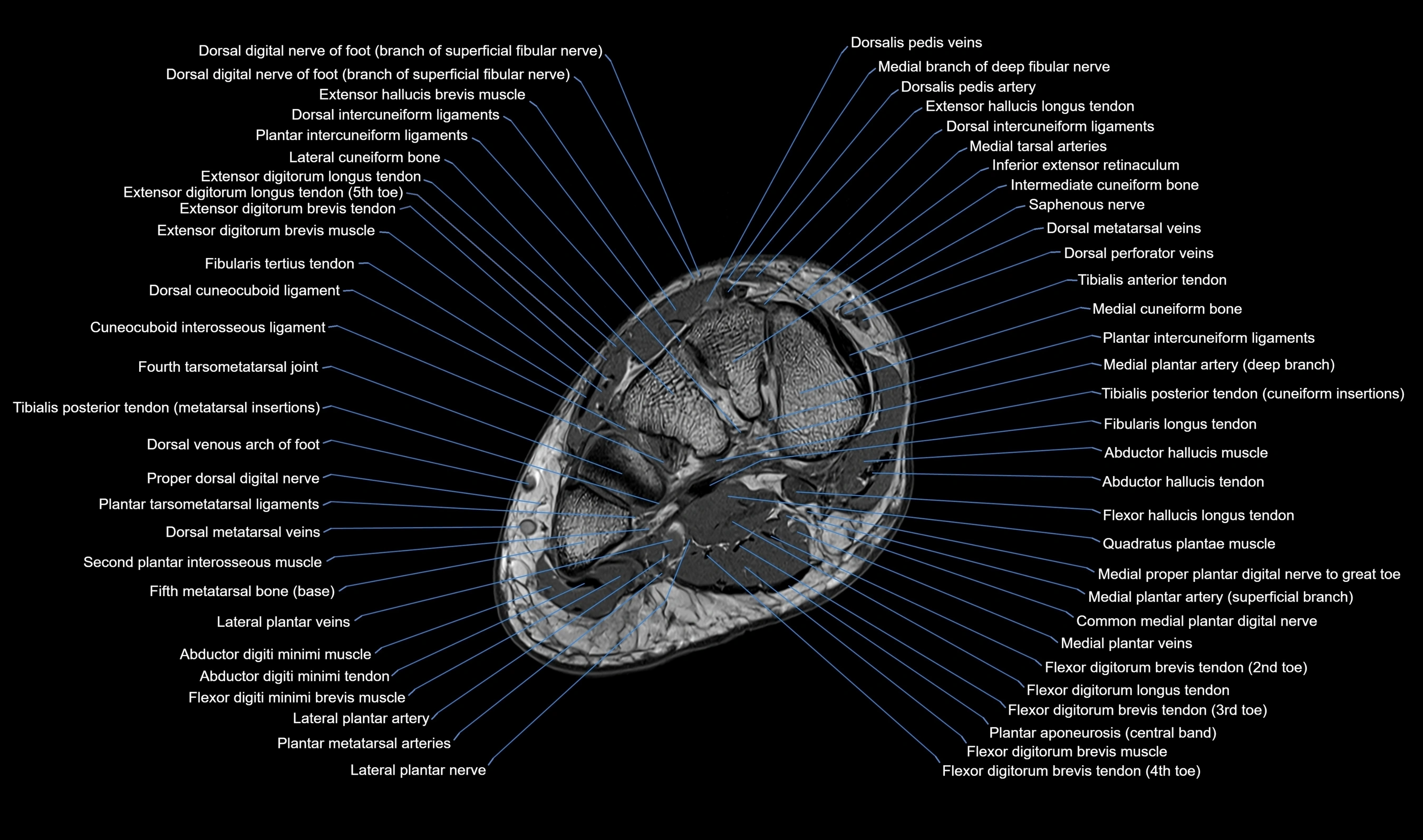MRI mid foot axial cross sectional anatomy 3T  radiology  image-img-00001-00021.webp